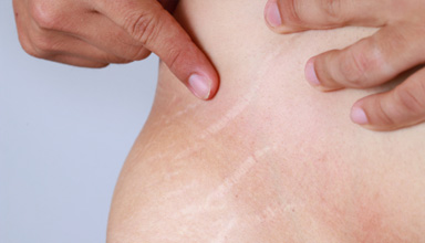 Stretch Mark Correction