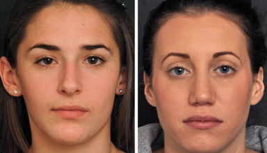 Complementary Fat Grafting