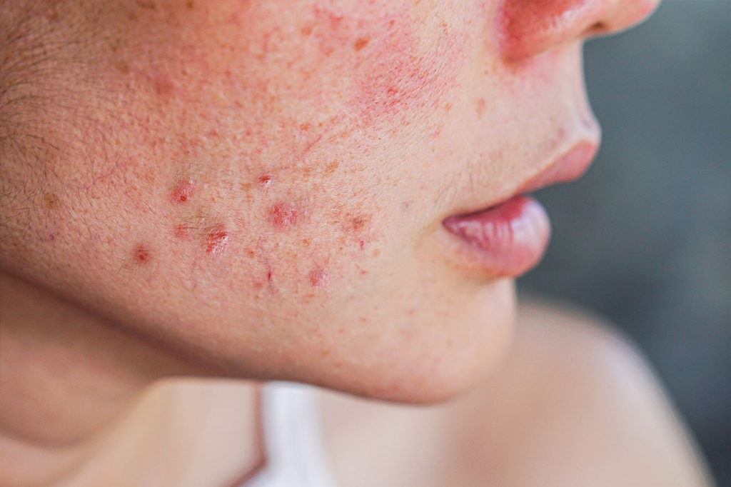 Laser Acne Treatment for PCOS