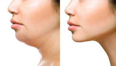 Double Chin Correction Liposuction