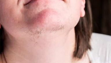 Hirsutism Treatment