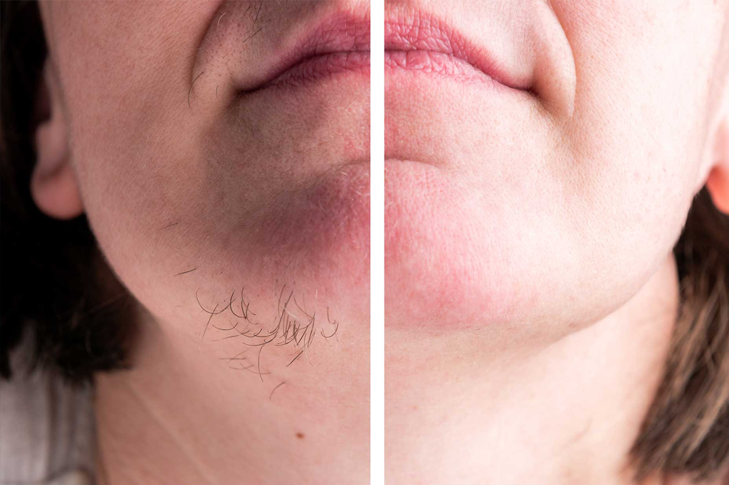 Laser Hair Removal for PCOS
