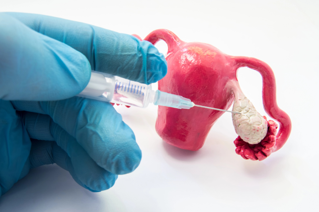 Ovarian Drilling for PCOS