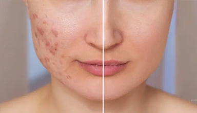 Acne Scars Treatment
