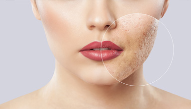 Laser Scar Reduction