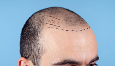 Follicular Unit Transfer (FUT)