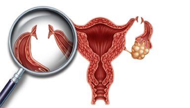 Permanent Sterilization