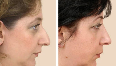 Rhinoplasty