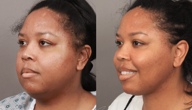 Buccal Fat Removal