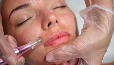 Microneedling