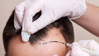 Follicular Unit Extraction (FUE)