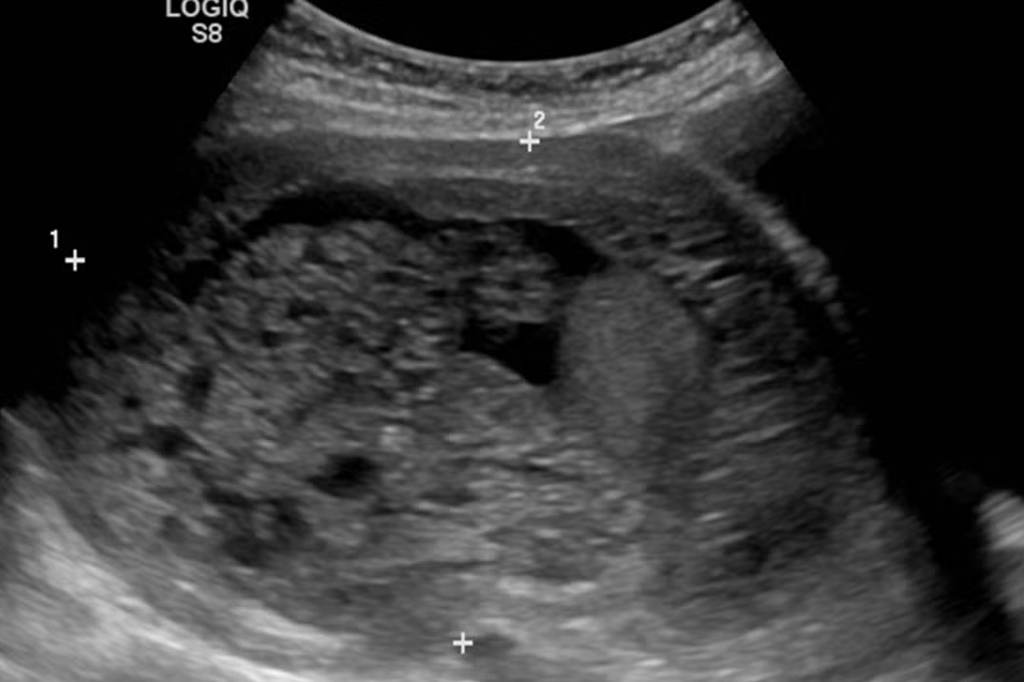 Molar Pregnancy