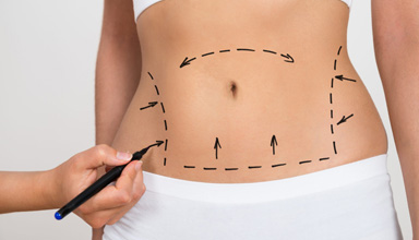 Tummy Tuck Abdominal Liposuction
