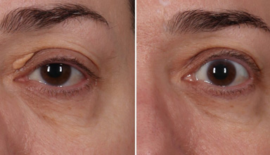 Xanthelasma Treatment