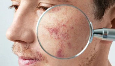 Birthmarks and Scar Correction