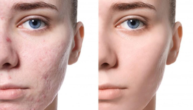 Laser Acne Treatment