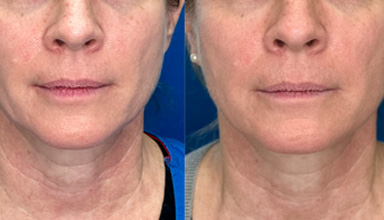 Endolift