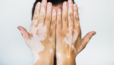 Melanocyte Transfer (Vitiligo)
