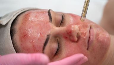 Vampire Facial