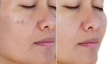 Melasma and Freckles Treatment