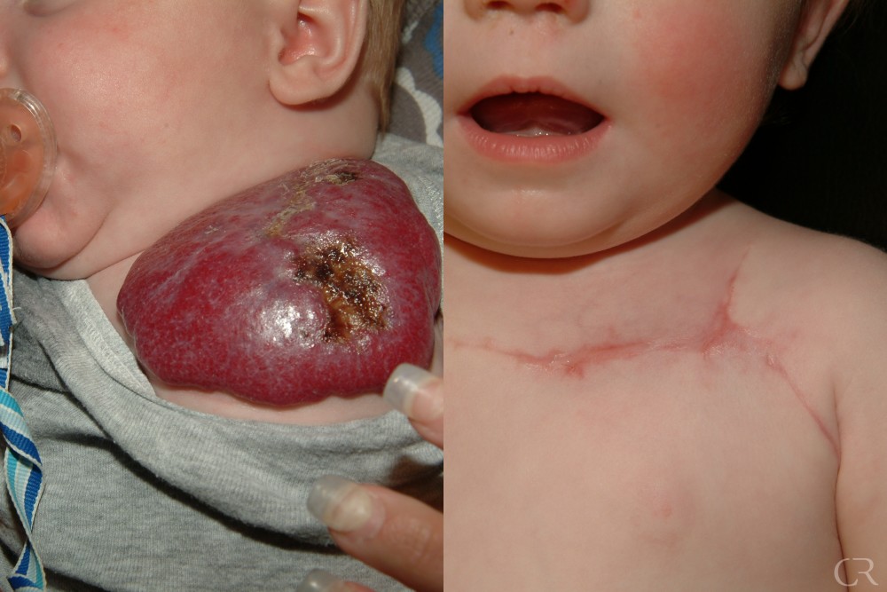 Hemangioma and Vascular Malformations