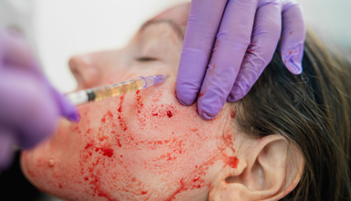 Vampire Facial