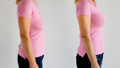 Breast Lift