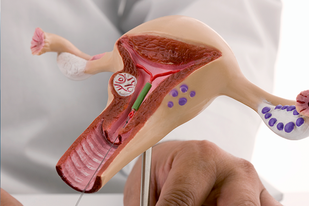 IUI (Intrauterine Insemination) And Ovulation Monitoring
