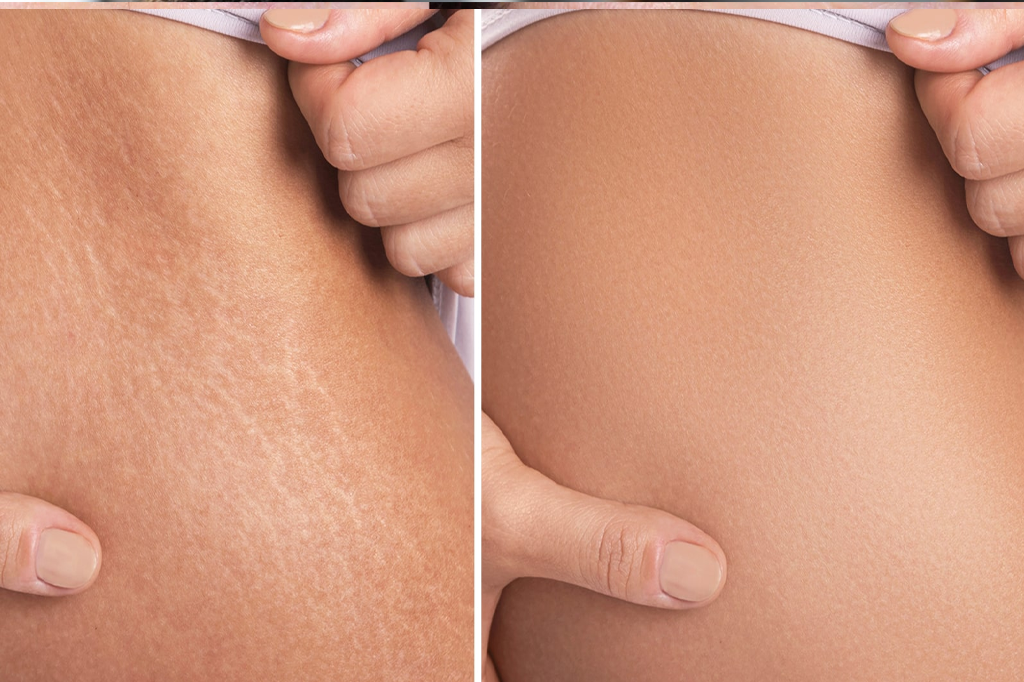 Stretch Mark Laser/PRP