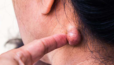Scrotal Sebaceous Cyst Removal
