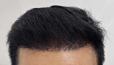 Hair Transplant