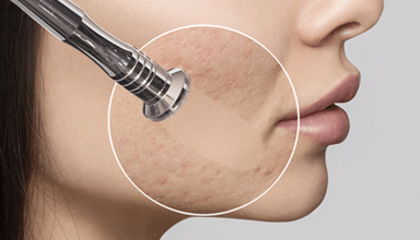 Microdermabrasion