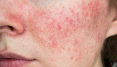 Rosacea Redness Diffuser