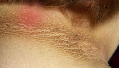 Acanthosis Treatment
