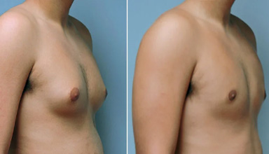 Gynecomastia Surgery