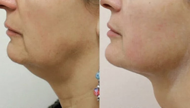 HIFU (High-Intensity Focused Ultrasound)