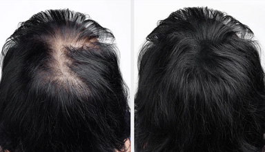 Threads for Hair Restoration