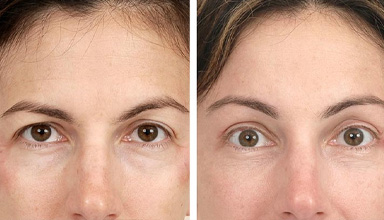 Browlift
