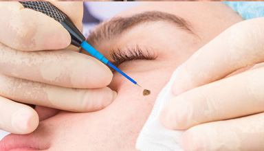 Cyst, Lipoma, Moles, and Warts Removal