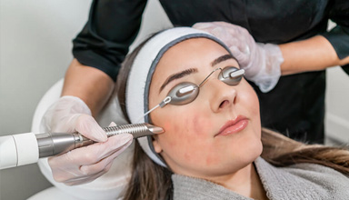 Laser Acne Treatment