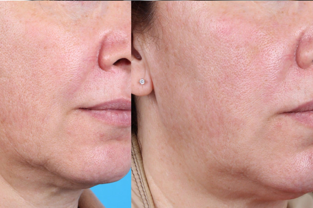 PRP Rejuvenation