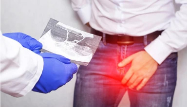 Varicocele Surgery