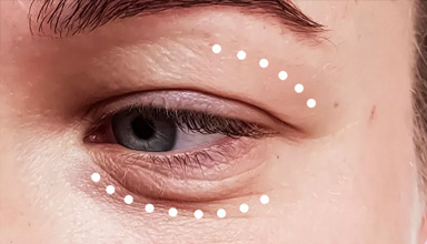 Blepharoplasty