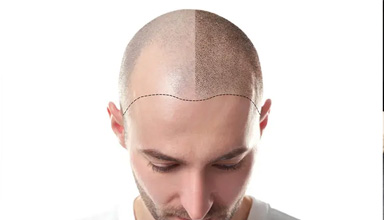 Micropigmentation
