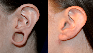 Earlobe Repair