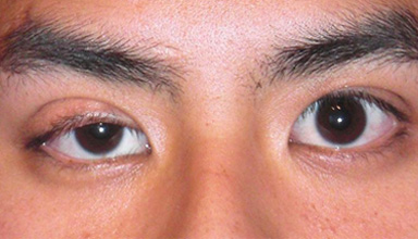 Ptosis Surgery