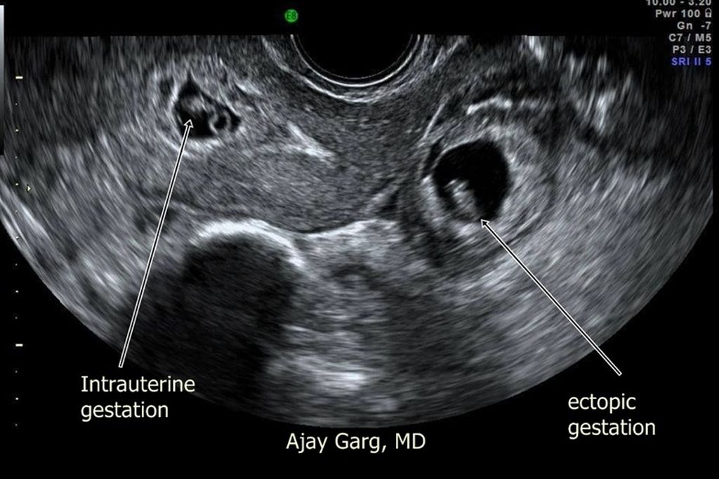 Ectopic Pregnancy