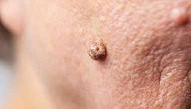 Keloid, Cyst, and Lipoma Removal