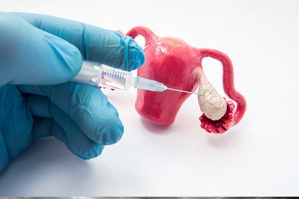 Ovulation Induction