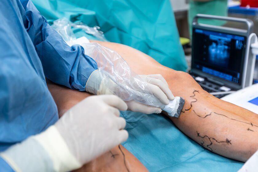 Varicose Vein Treatment